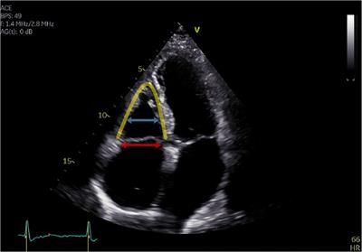 Procedural success of transcatheter annuloplasty in ventricular and atrial functional tricuspid regurgitation